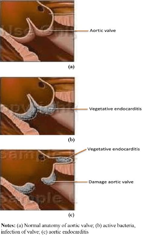 Bacterial Endocarditis Of The Aortic Valve Download Scientific Diagram