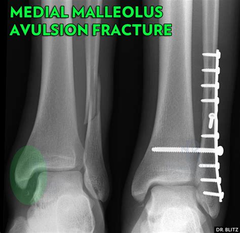 Types de fractures de la cheville en malléole interne