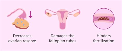 What Effects Does Endometriosis Have On Fertility