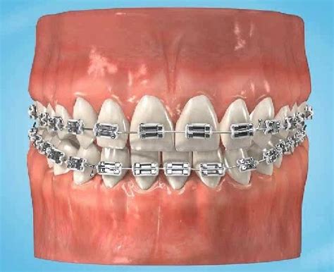 Have You Got Braces Have You Broken A Bracket Signature Smiles Dental