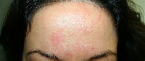 I Have A Rash On Face The Dermatologist Told Me To Take Lupus