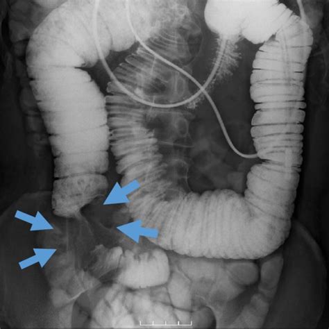 Small Bowel Series Via The Ileus Tube Shows Severe Obstruction In The