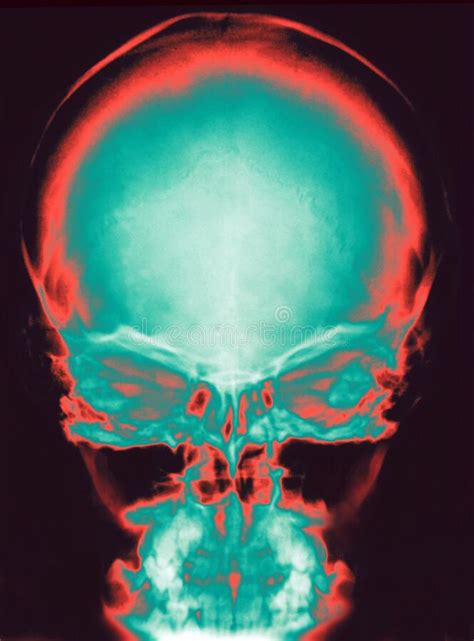 Human Skull X Ray Stock Photo Image Of Healthcare 225241918