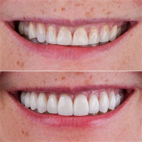Cosmetic Dentistry Before After Photos Porcelain Veneers Pictures