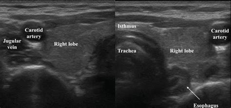 Normal Thyroid Appearance And Anatomic Landmarks In Neck Ultrasound