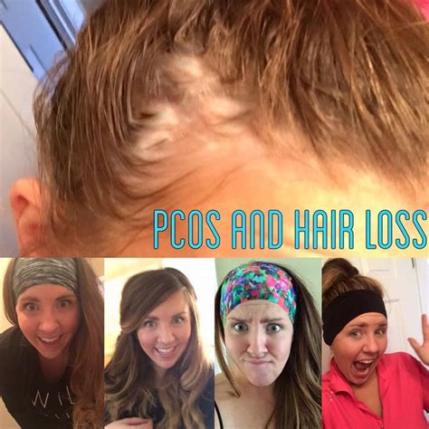 PCOS Hair Loss And Amazing Headbands Surviving Shelby Pcos