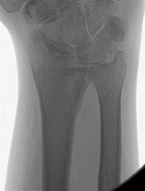 Lunate Facet Malunion With Osteotomy East Bay Hand Medical Center