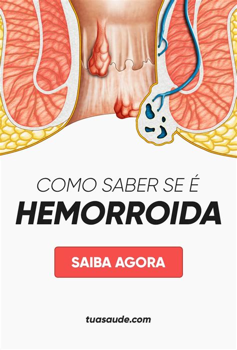 O principal fator predisponente à trombose é o fato de possuir hemorroidas externas. O que é Hemorroida e Como tratar em 2020 | Remédio para ...