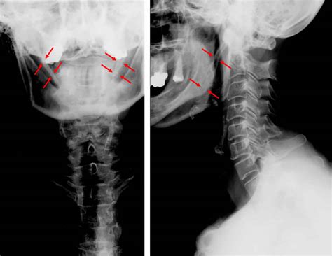 Eagle Syndrome Causes Symptoms Diagnosis Treatment And Prognosis