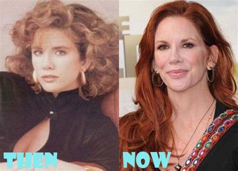 Melissa Gilbert Plastic Surgery Before And After Photos Lovely Surgery
