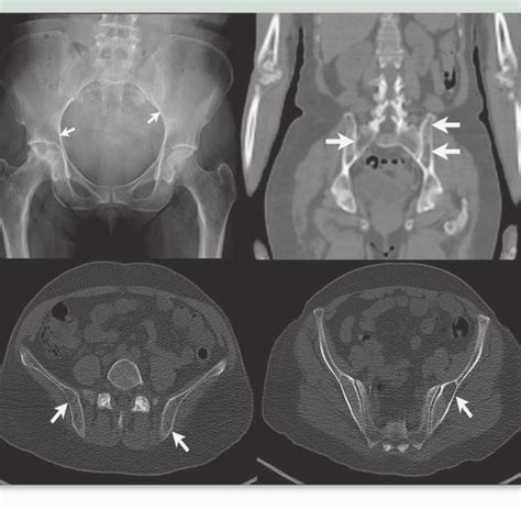 A Patient With Multiple Myeloma And Subtle Lucencies In The Bony Pelvis