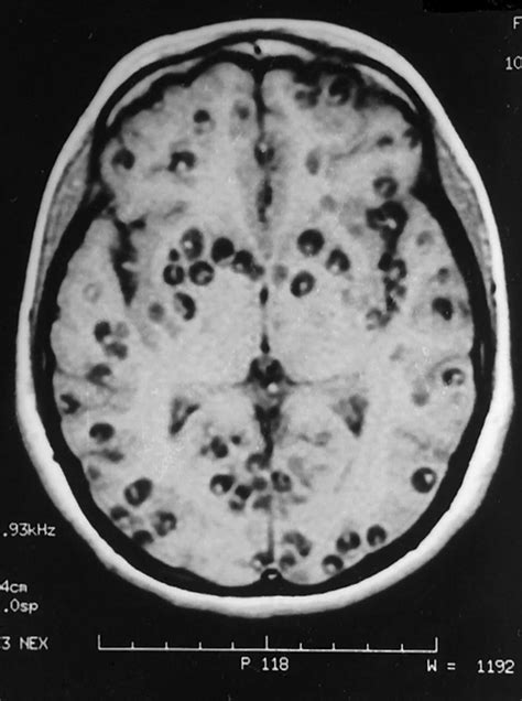 Neurocysticercosis Causes Symptoms Diagnosis Treatment And Prognosis