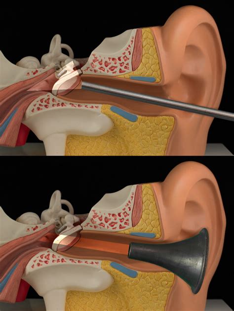 Advanced Ear Surgery Technique Restores Hearing Attracts International Patients