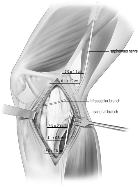 Structures Of The Knee Injuries To The Medial Collateral Ligament And