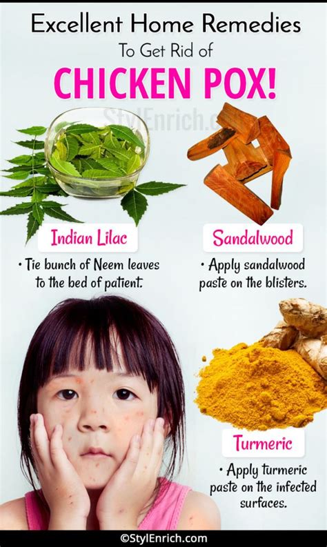 Home Remedies For Chickenpox Natural Ways To Get Cured