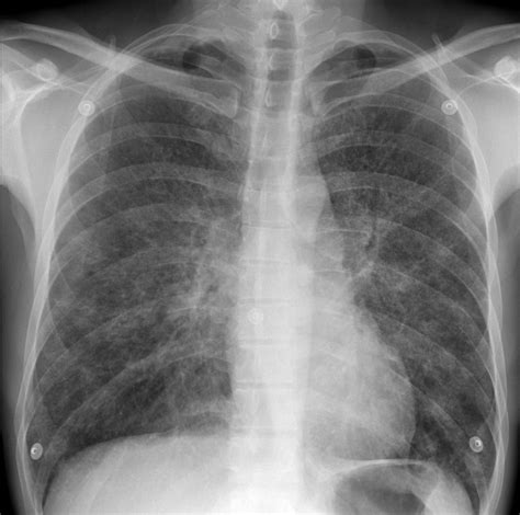 Feature extraction methods like dwt, wft, and wpt can also be used. Pneumocystis pneumonia | Image | Radiopaedia.org