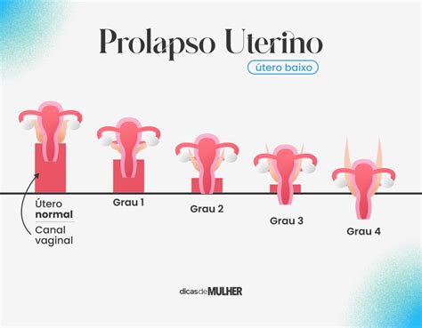 Prolapso uterino causas e tratamentos para colo do útero baixo