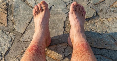 Petechiae Causes Treatments Pictures And More