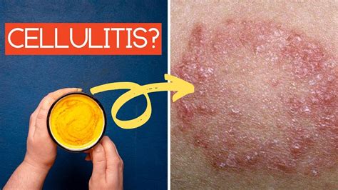 Treating Cellulitis At Home 7 Home Remedies For Cellulitis