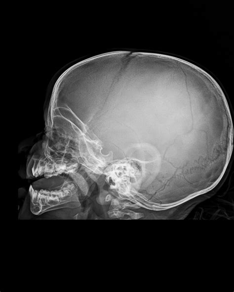 Skull Fracture Linear Image