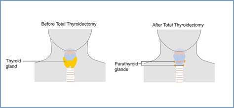 Thyroidectomy Partial Total Yellowstone Surgery Center