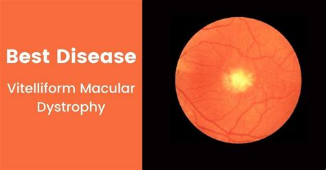 What Is The Best Disease Of The Eye Vitelliform Macular Dystrophy