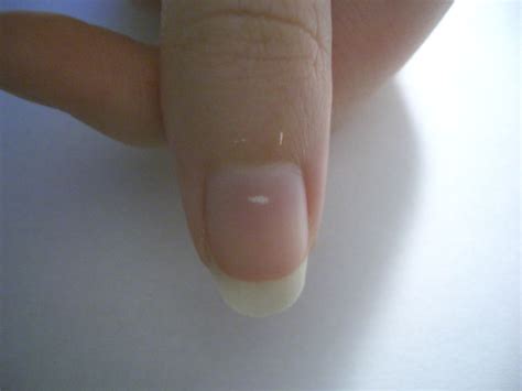 It's caused by a deficiency of melanin, a pigment in your skin which actinic keratosis is a condition that causes a small, raised, rough area on skin. Teen Tips: Nail Care