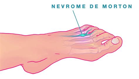 N Vrome De Morton Hallux Valgus Nice Chirurgie Pied Nice