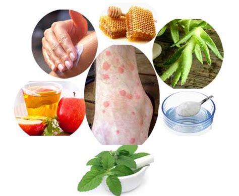 6 Home Remedies For Mosquito Bites Home Health Beauty Tips