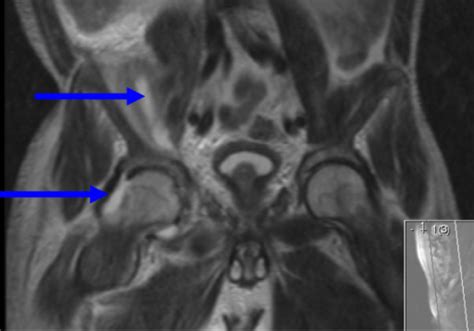 A T2 Weighted Mri Image Of The Pelvis In The Coronal Pl Open I