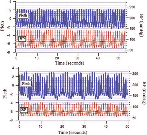 The Effect Of Blood Loss On The Pulse Oximeter Waveform Pleth And