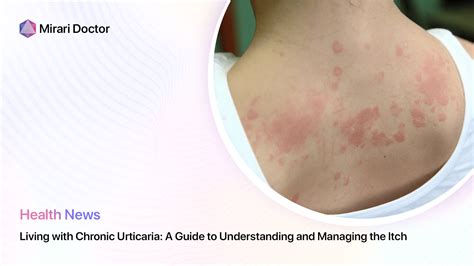Living With Chronic Urticaria A Guide To Understanding And Managing