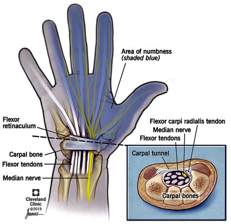 Carpal Tunnel Syndrome Photo