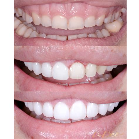 Picasso Porcelain Veneers Before And After Kelly Edwards Vogue