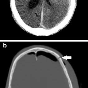 CT Images From A Large Subdural Hematoma SDH With Midline Shift A