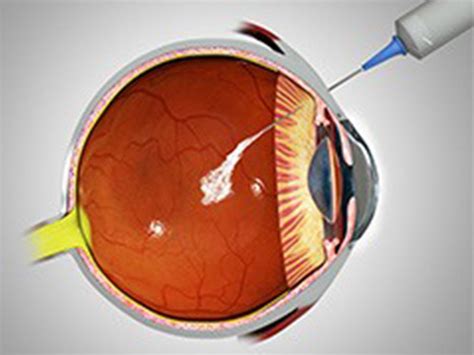 Intra Vitreal Injection For Eye Problems Kochi Dr Tony Fernandez Eye