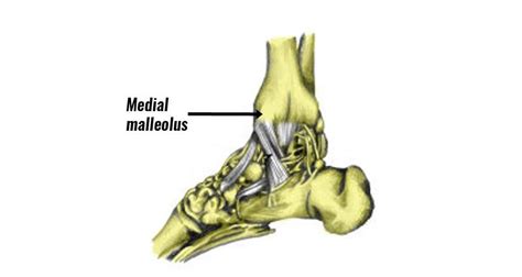 Medial Malleolus Stress Fracture Symptoms Cauess And Treatment