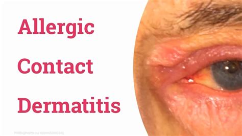Allergic Contact Dermatitis Of Eyelid Youtube
