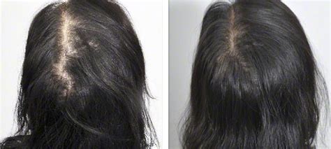 Hair Loss Before And After Kingsway Dermatology