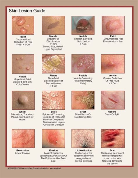 1000 Images About Dermatology On Pinterest Sebaceous Cyst Skin