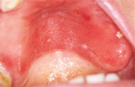 Denture Stomatitis Gigigeligicom