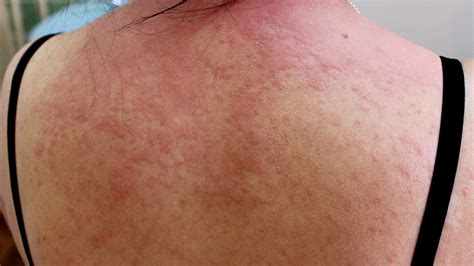 Acute Hives Causes Symptoms And Treatment Hives Treatments