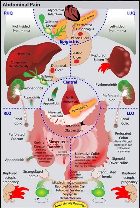 Abdominal Pain Differential Diagnosis By Quadrants Gr