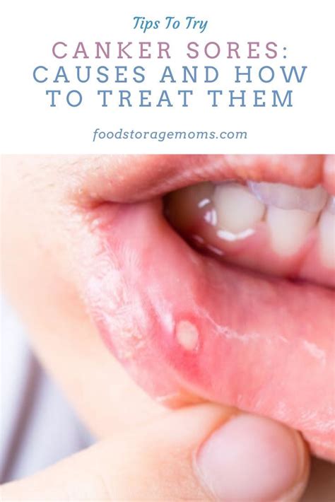 Canker Sores Causes And How To Treat Them Canker Sore Canker Sore