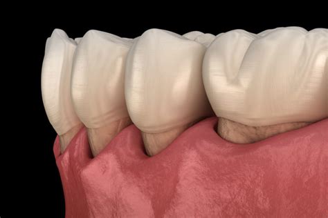 Gum Recession 3 Facts About Why Gum Tissue Recedes Advanced