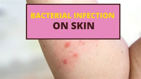 How To Treat A Bacterial Infection On Skin Useful Tips And Tricks