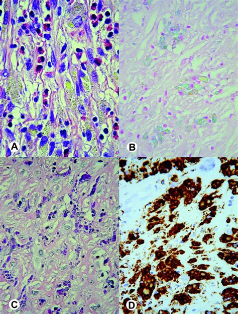 Histological Sections Showing Macrophages Containing Drop Shaped