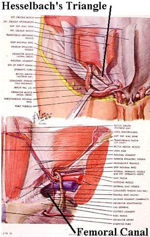 What is an inguinal hernia? Direct Inguinal Hernias | General Surgery | Tools for Work | Pinterest | General surgery ...