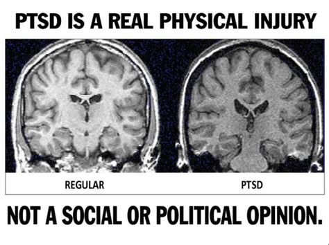 As You Can See Ptsd Actually Changes The Brain Structure And Function