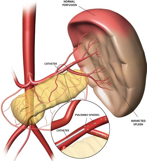 Splenic Arterial Interventions Anatomy Indications Technical Considerations And Potential